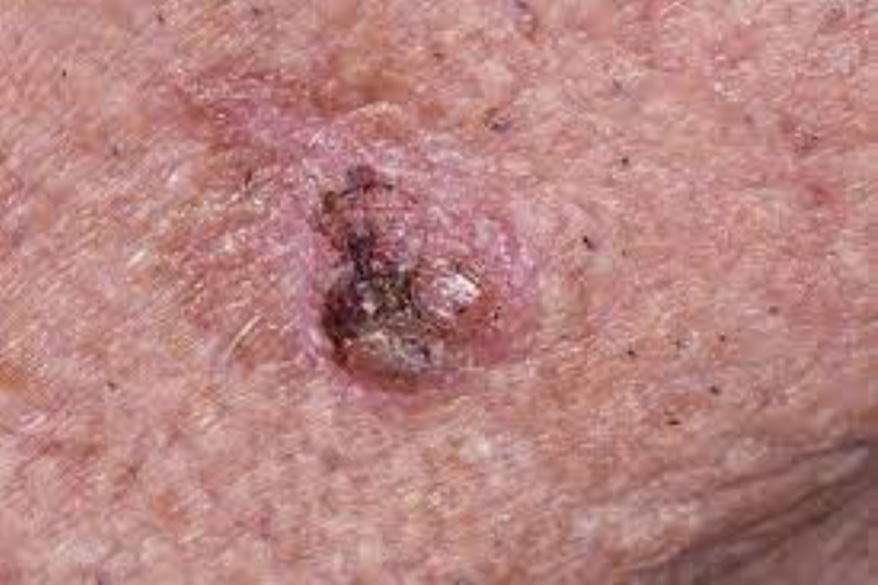 skin cancer due to long exposure to UV rays | Irispro